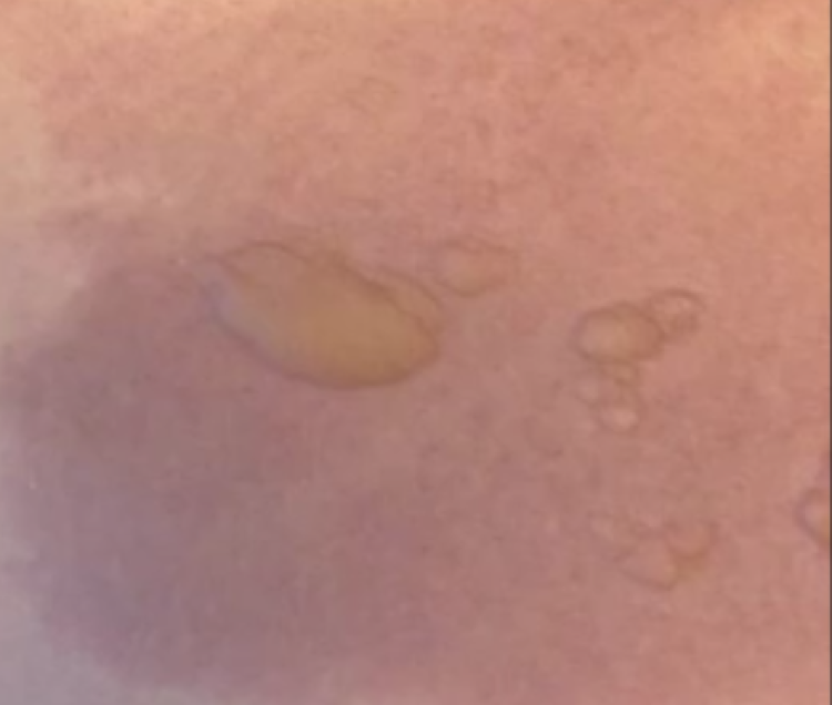 Sıcak Su Torbası Patladı, Genç Kadın Yanıklarla Hastaneye Kaldırıldı (1)